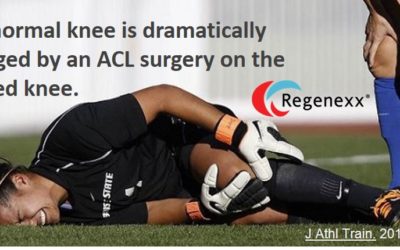 Beware During ACL Surgery Rehab! ACL Surgery Dramatically Impacts the Uninjured Knee!