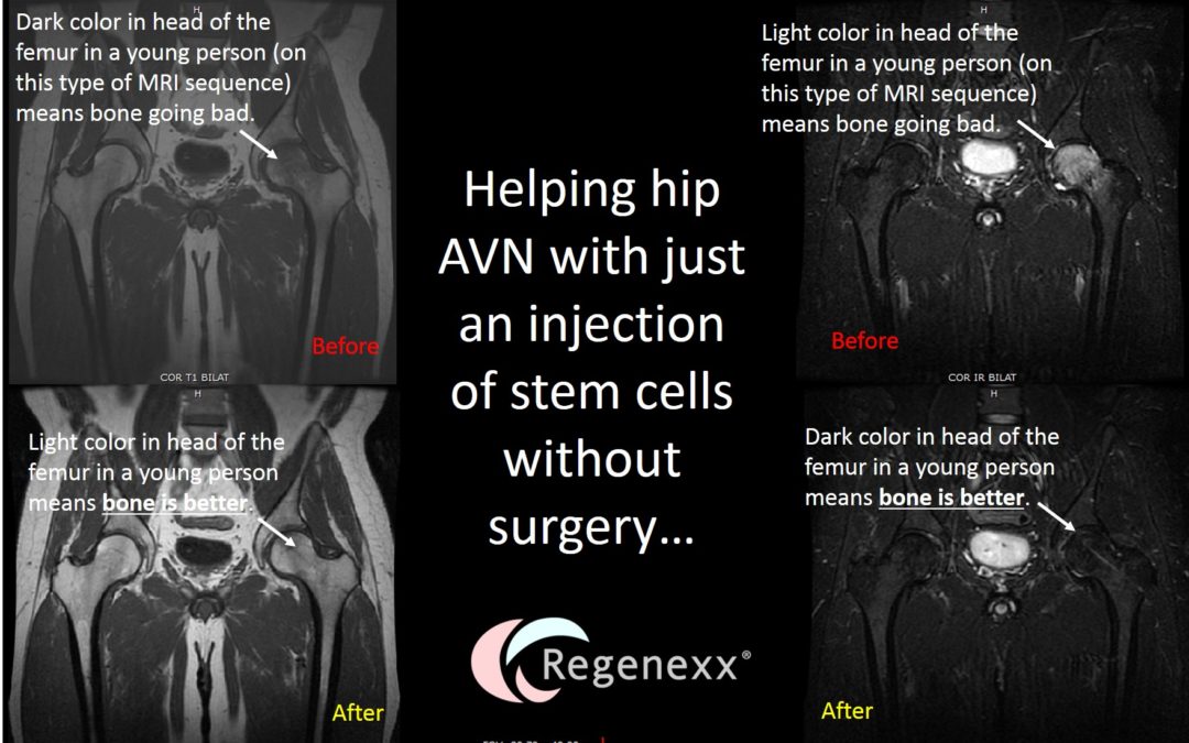 Hip AVN Surgery Alternative: Another Hip AVN Patient Treated with Stem Cells