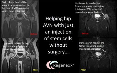 Hip AVN Surgery Alternative: Another Hip AVN Patient Treated with Stem Cells