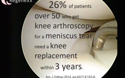 Knee Arthroscopy Alternatives? 1 in 4 Patients End up with a Rapid Knee Replacement!
