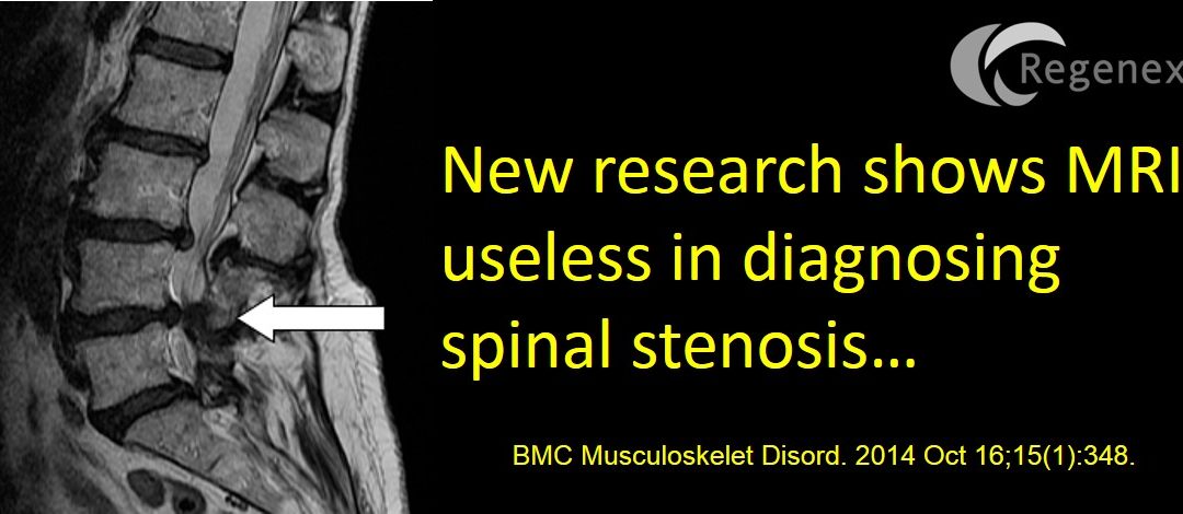 Spinal Stenosis Injections: Never Trust a Back MRI!