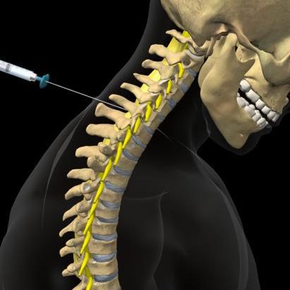 Cervical epidural steroid injection in the neck