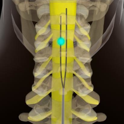 Spinal Cord Stimulator South County, Back Pain