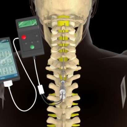 a peripheral nerve or dorsal column stimulator